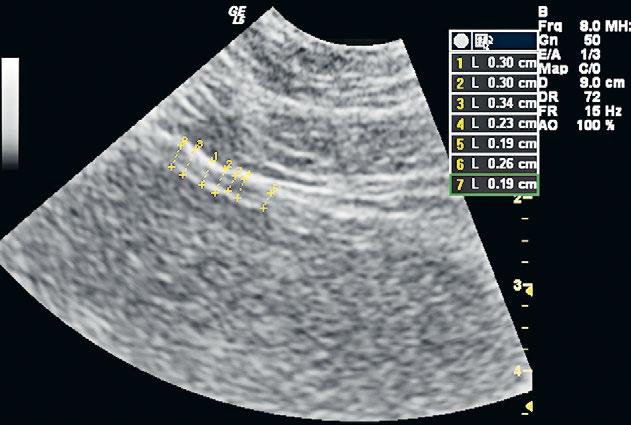 294 Vasileios I. Sakalis et al Subtle errors of bladder wall thickness measurement have a significant impact Fig 1. Ultrasonographic image of bladder wall using an 8.