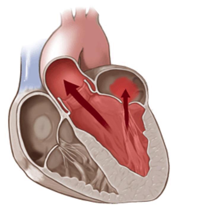 Mitral Valve Regurgitation (MR) Occurs when the valve that separates the atrium from the ventricle on the left side of the heart does not close properly allowing blood to flow back into
