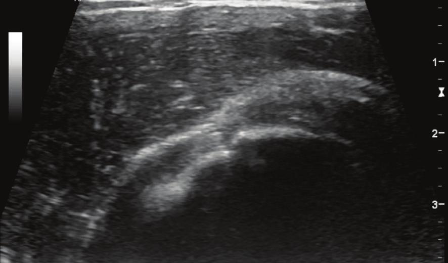 2 Case Reports in Radiology Del SS SS HH SC SC HH T T Figure 1: Ultrasound (US) images of both shoulders. US parasagittal image of the left shoulder rotator interval.