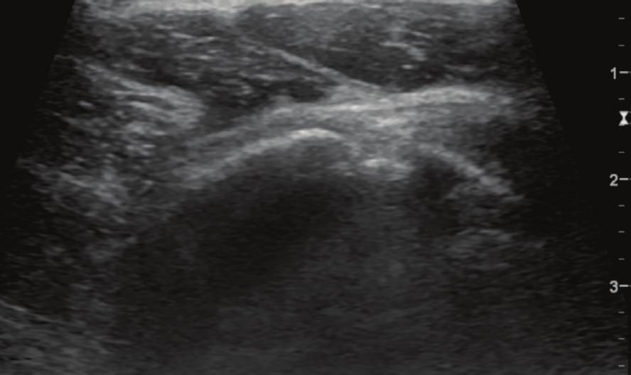 The long head of the biceps tendon is not discernible in its normal position (white arrow). HH = humeral head; SS = supraspinatus tendon; SC = subscapularis tendon; Del = deltoid muscle.