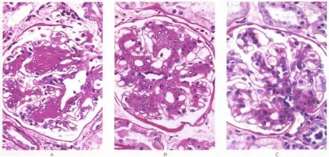 Biopsy Study Glomerular Sclerosis After Pancreas