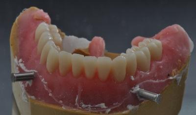 Process acrylic. When processing on a master cast, do not remove the denture until the attachments are cured into position.
