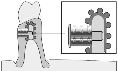 A 1:1 mixture of Ceka site may be used to bond the Plunger Lock attachment into the framework, or
