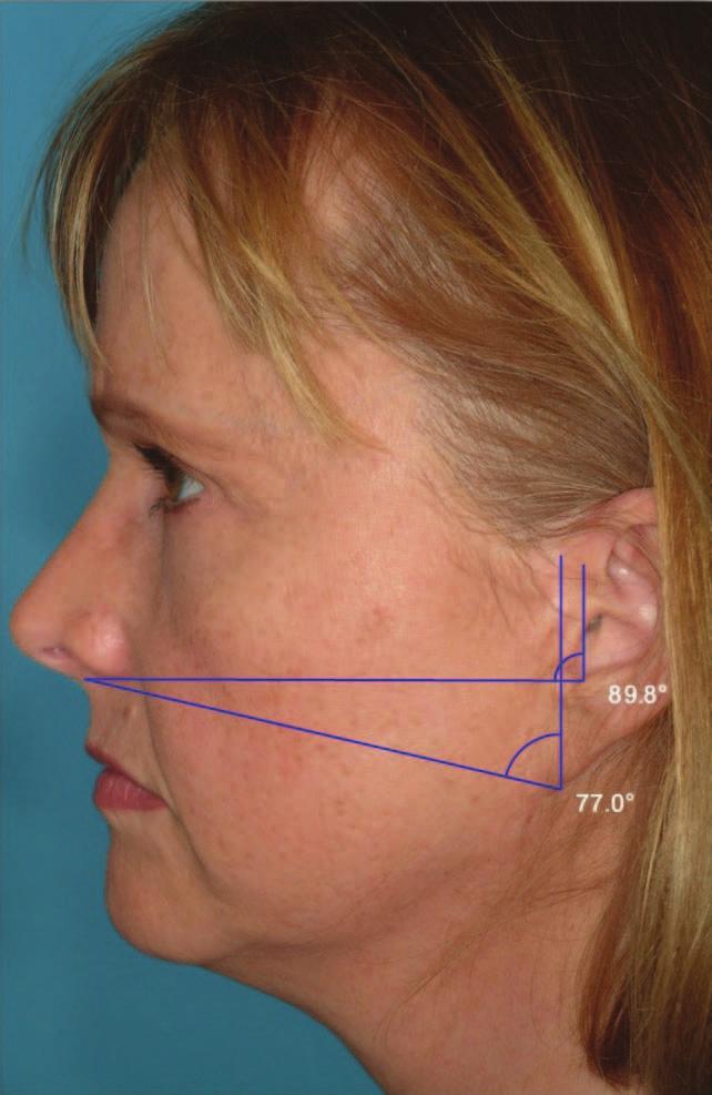 This deformity of the ear can be seen before placement of the last suture in the classical facelift technique, while the patient is still supine on the operating table and before gravity worsens the