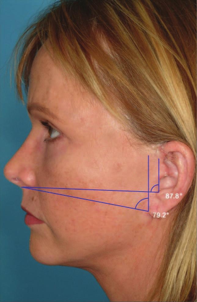 This situation worsens with time as the impact of gravity further affects the ear; the soft tissue of the ear is very delicate and may become elongated on its own.
