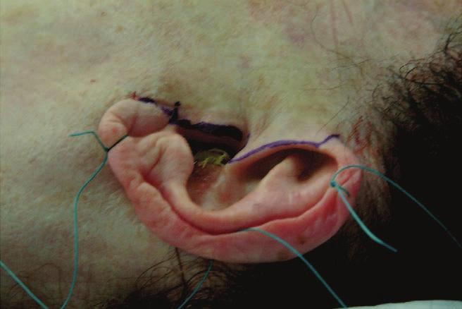 Figure 3. Incisions in the interior part of the ear. with autologous fat and the entire ear is elevated relative to its preoperative position.