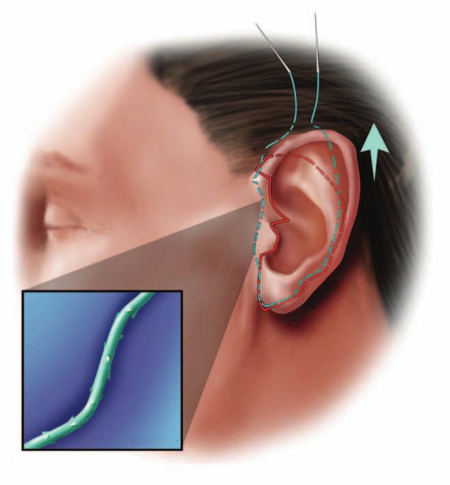 Another option is removal of the hairless skin at the top of the ear. TECHNIQUE Between January 2005 and November 2007, the author performed facelifts on 106 patients.
