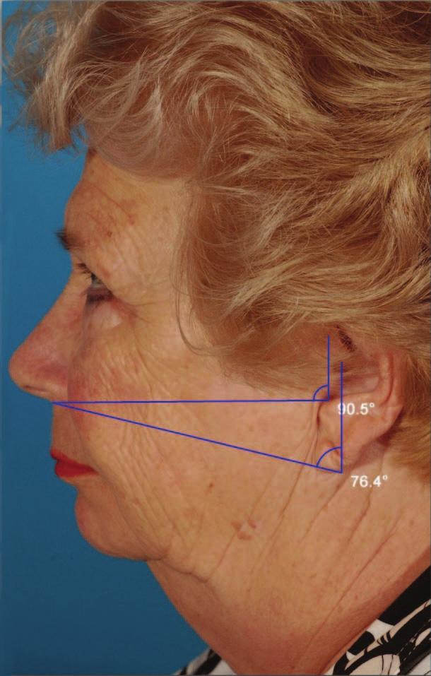 Measurements Through the retrospective examination of preoperative patient photographs, midface vectors and angles were calculated by measuring the angles created by the intersection vertical vectors