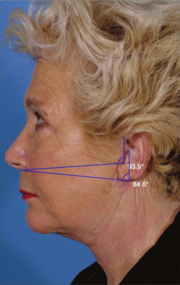 These angles (as they appeared in postoperative photographs) were recalculated at three months for all patients by an independent reviewer to determine the degree of improvement.