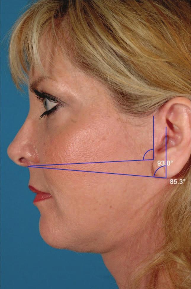This is accomplished by removing a small, triangular portion of the earlobe skin. A similar technique was also suggested by Lindgren and Carlin.