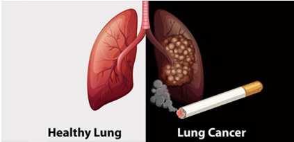 Gene Mutations in Non Small cell lung cancer Worldwide Lung cancer is the most common cause of cancer-related death in men and women.