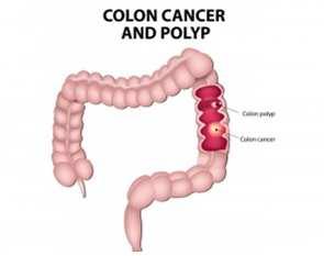 Molecular Markers in Colorectal Cancer & their targeted therapies Colorectal cancer is a disease originating from the epithelial cells lining the colon or rectum of the gastrointestinal tract, most