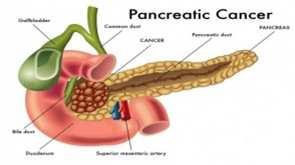 Molecular Markers & Targeted therapies in Pancreatic Cancer Pancreatic cancer arises from the cells of the pancreas, which begin to multiply out of control and form a mass.