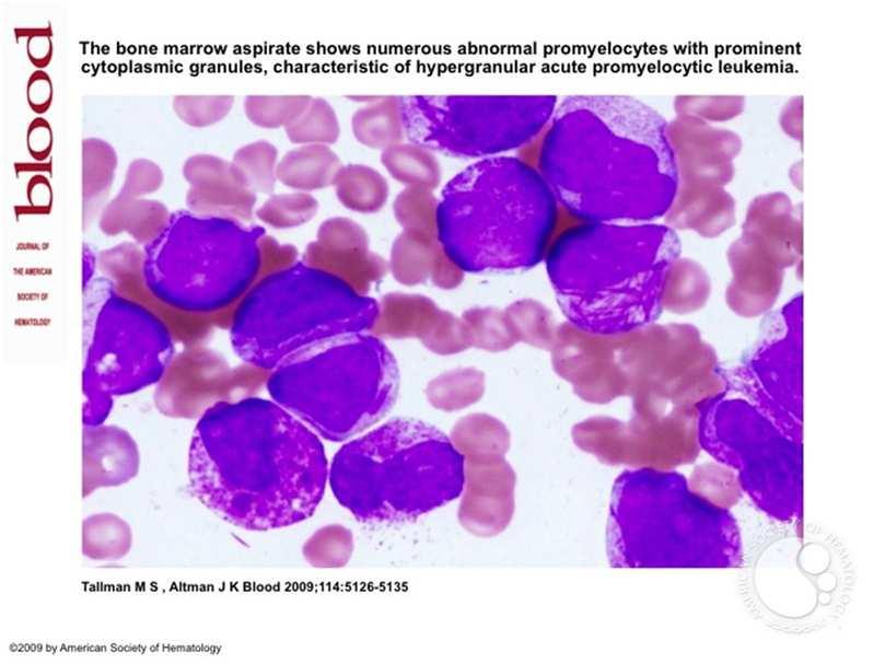 Acute Promyelocytic Leukemia Molecular Analysis
