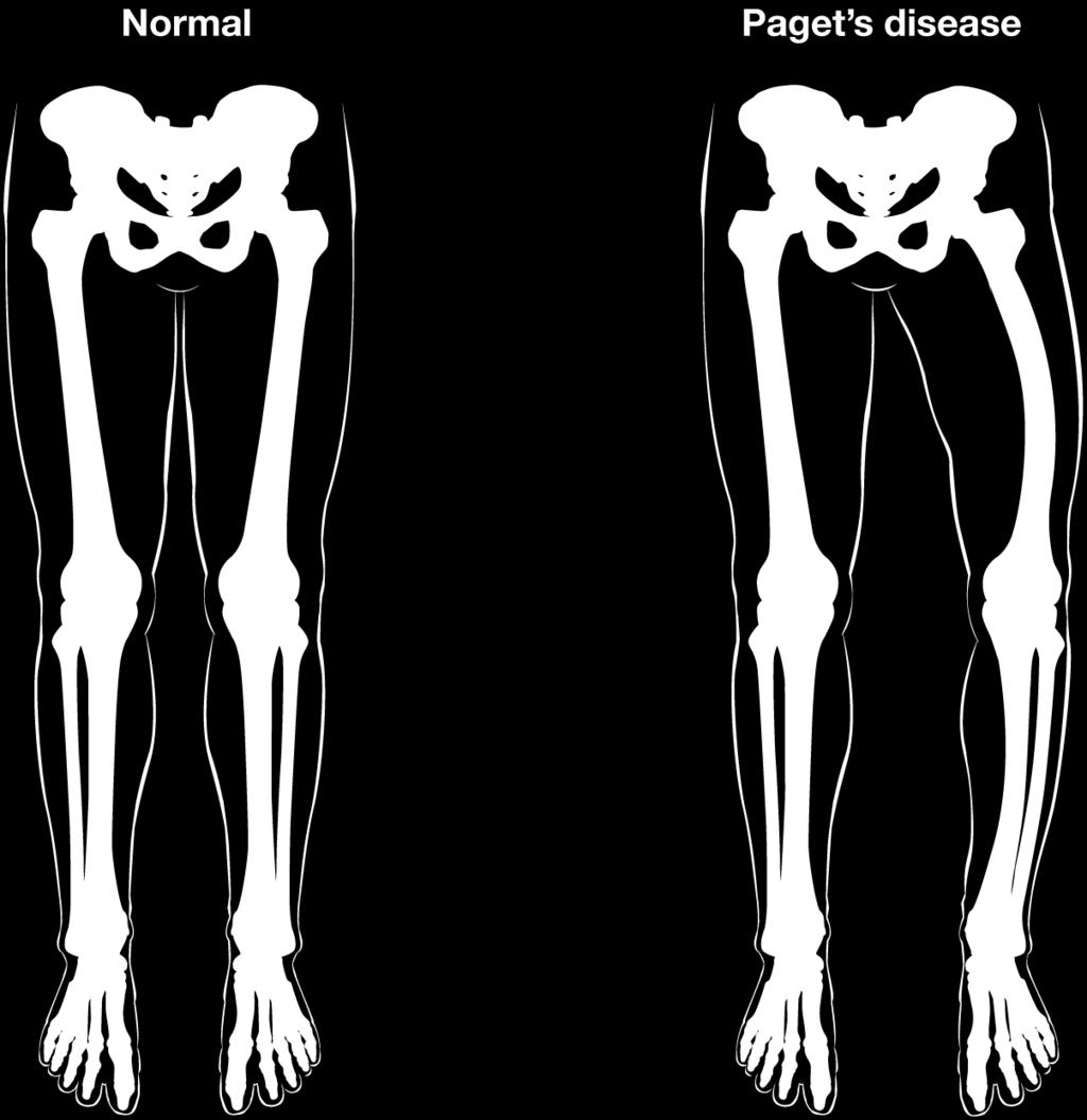 Paget's disease is diagnosed via imaging studies and lab tests. X-rays may show bone deformities or areas of bone resorption. Bone scans are also useful.