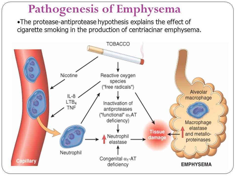 PATHOGENESIS Emphysema is caused by exposure to toxic substances such as tobacco smoke and inhaled pollutants which induce inflammation with accumulation of neutrophils, macrophages and lymphocytes