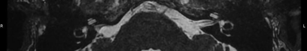 Page 2 of 8 Australian Journal of Otolaryngology, 2018 Figure 1 T2 MRI slice of a normal vestibular labyrinth fluid signal post right retrosigmoid vestibular schwannoma resection.