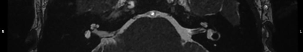 Australian Journal of Otolaryngology, 2018 Page 3 of 8 Figure 2 T2 MRI slice of an abnormal vestibular labyrinth fluid signal post right