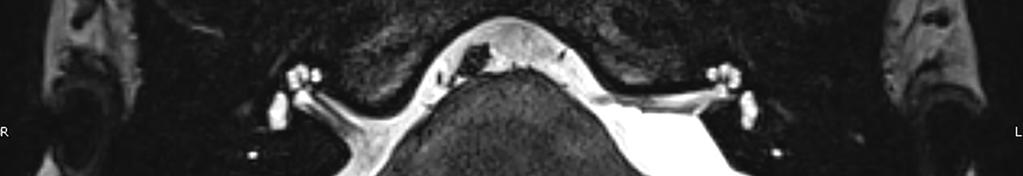 Figure 3 T2 MRI slice of a grade 0 cochlea fluid signal post left  Figure 4 T2 MRI slice of a grade 1 cochlea fluid signal post left 