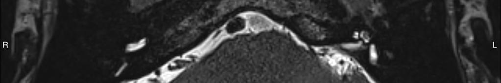 signal changes were evident on the first post-operative scan, the distance between the posterior semicircular canal and the CSF was