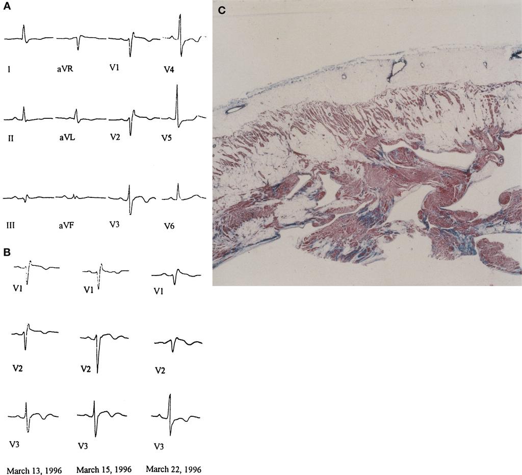 Corrado et al RBBB, ST-Segment Elevation, and Sudden Death 713 Figure 2. A 27-year-old man who died suddenly while sleeping.