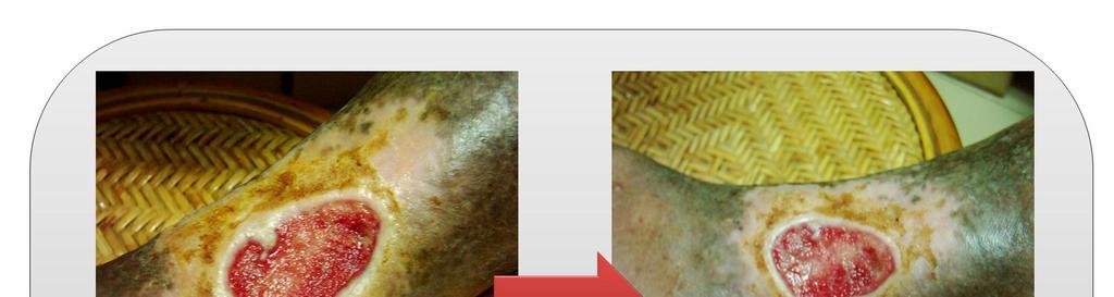 <Curative Case> Stasis Dermatitis is a skin disease that often occurs on the lower extremities of elder patients.