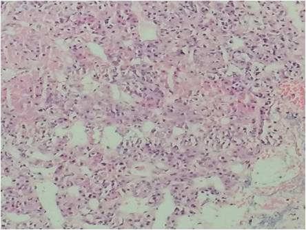 Image 7: Pituitary Adenoma [10x] Image 8: Pituitary Adenoma [40x] Image 9: Metastatic Papillary carcinoma [10x] Conclusion Neuroepithelial are the most common histological type followed by