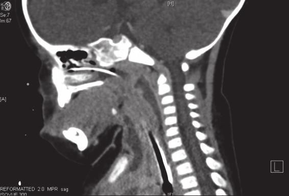 2 Case Reports in Pediatrics Figure 1: Sagittal and transverse CT images. Figure 2: Blood impacted endotracheal tube.