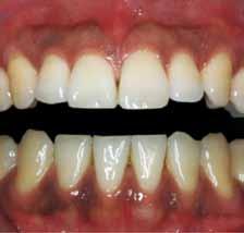 202 Abrasion with laser is effective in gingival depigmentation request their removal [7], particularly if the hyperpigmentation appears on the facial aspect of the gingiva, thus being, visible