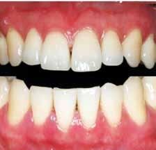 In particular, women are more conscious of the black or dark pigmentation patches on the facial aspects of the gingiva, which may be strikingly apparent during smiling and speaking [8].