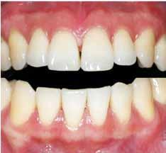 CASS SCRIPTION Study population The study included three patients requesting an esthetic treatment for gingival melanin hyperpigmentation in the anterior part of the maxilla and mandible at Kyungpook