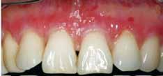 A free gingival graft usually requires an additional surgical site and a careful concern for color matching.