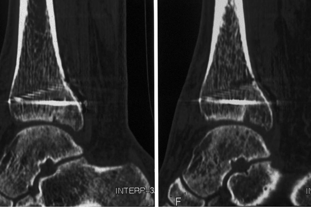 However, in the medial part of the plafond (B) and adjacent to the medial malleolus (C) posterior subluxation of the talar dome occurs (anterior opening of the joint).