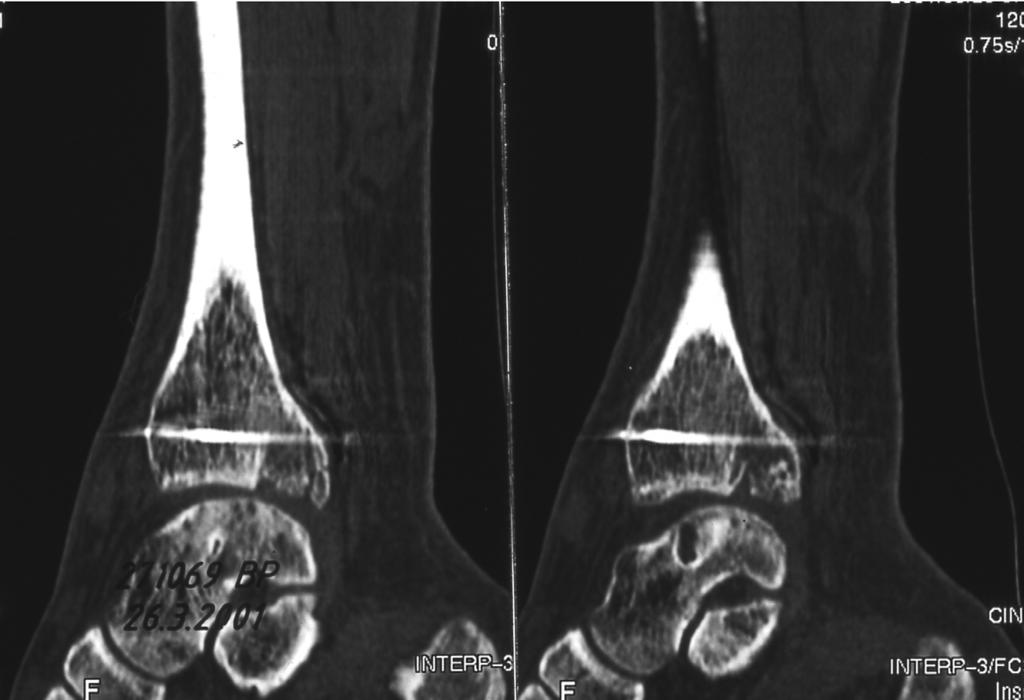726 WEBER Foot & Ankle International/Vol. 25, No. 10/October 2004 C Fig. 10: Continued Future follow-up will show the long-term prognosis of these fracture-dislocations. REFERENCES Fig.