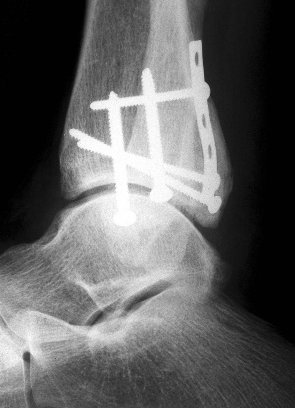 1. Geissler, WB; Tsao, AK; Hughes, JL: Fractures and injuries of the ankle. In: Rockwood CA, Green DP, Bucholz RW, Heckman JD, eds. Fractures in adults. 4 th ed.