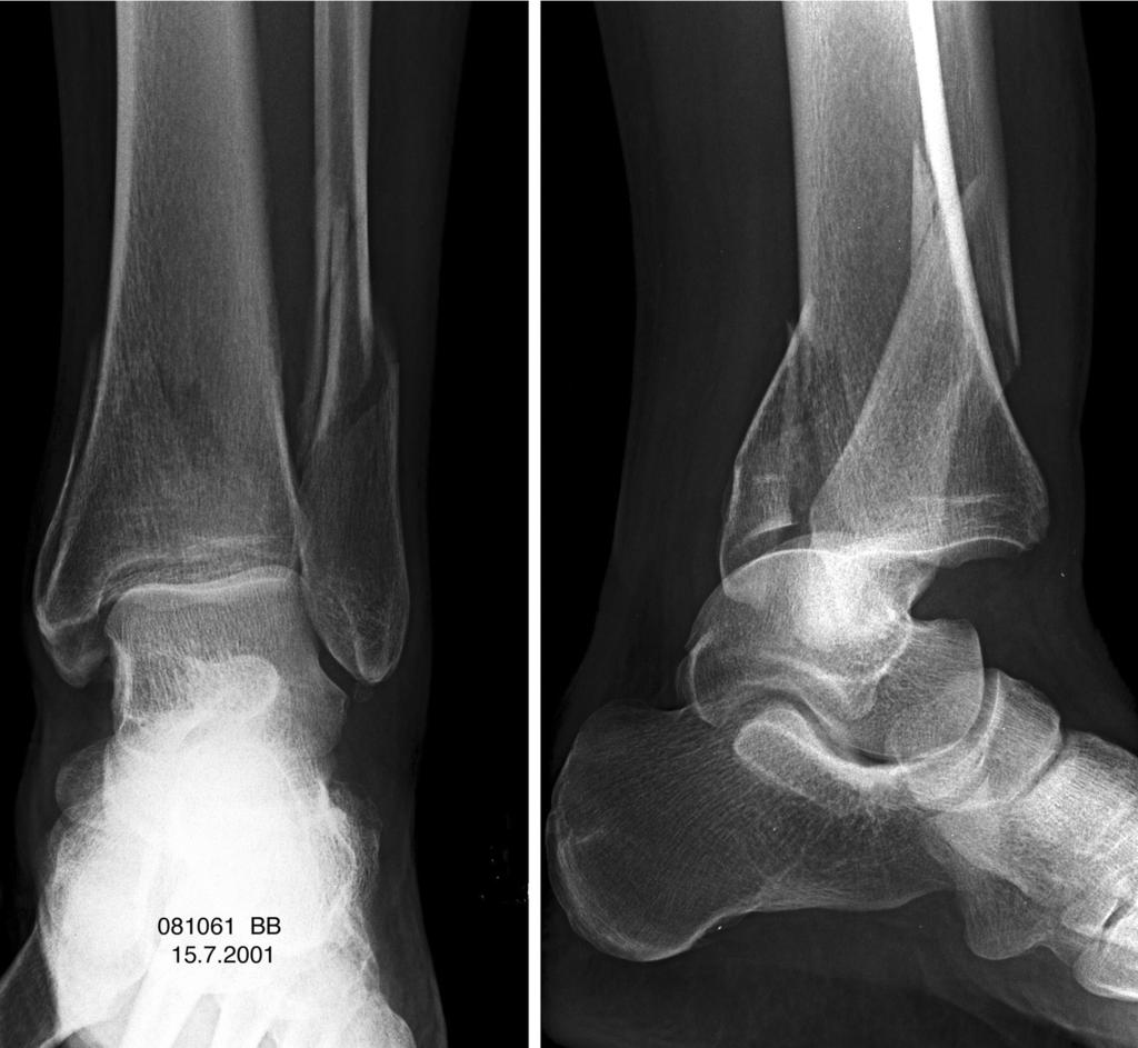 Foot & Ankle International/Vol. 25, No. 10/October 2004 TRIMALLEOLAR FRACTURES 719 Fig. 3: Anteroposterior and lateral radiographs of a malleolar fracture with posterior dislocation (patient no 6).
