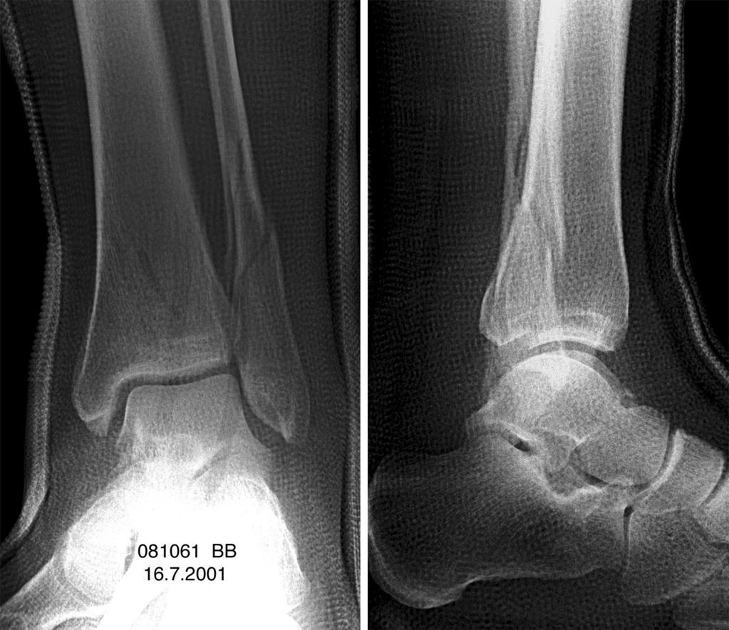 720 WEBER Foot & Ankle International/Vol. 25, No. 10/October 2004 Fig. 4: Anteroposterior and lateral radiographs of the same patient s ankle after closed reduction.