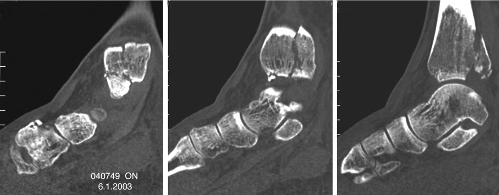 Foot & Ankle International/Vol. 25, No. 10/October 2004 TRIMALLEOLAR FRACTURES 721 A B Fig. 5: CT of the ankle of a patient (Table 1: no. 10). A, Malleolus and medial border of the plafond.