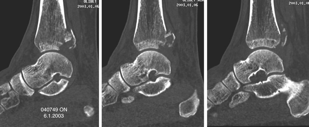 This patient had an additional fracture of the tip of the anterior colliculus (Figure 5,A left image, open arrow).