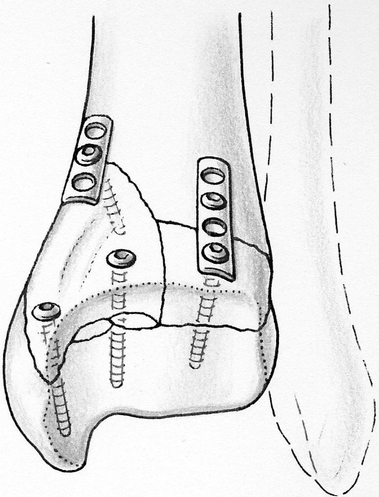 Foot & Ankle International/Vol. 25, No. 10/October 2004 TRIMALLEOLAR FRACTURES 723 Fig.