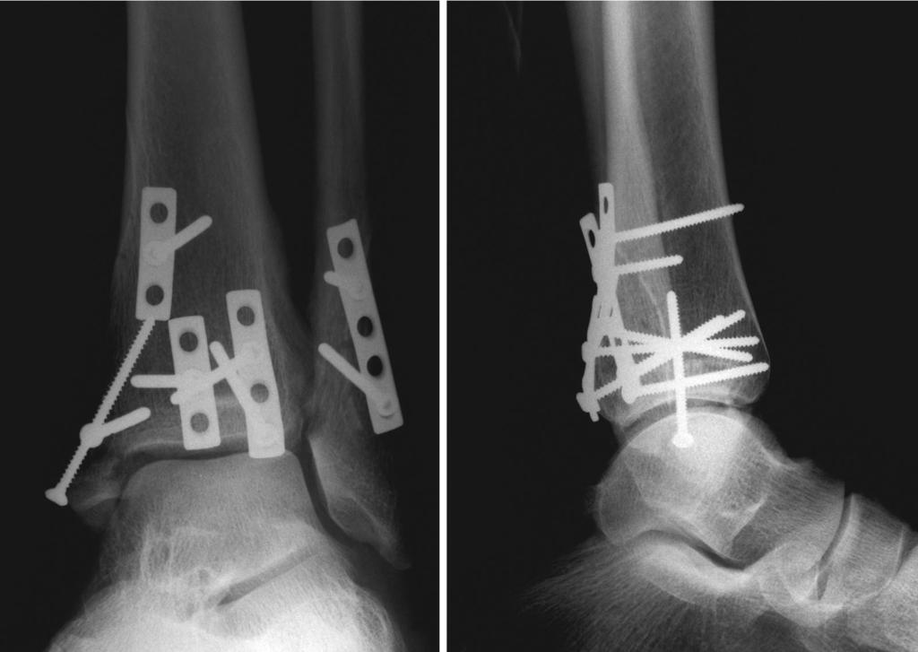 posterior tibial tendon (groove) and devascularize the fragment. The posterolateral fragment is fixed with a small-fragment (2.7 mm) antiglide plate and a lag screw.