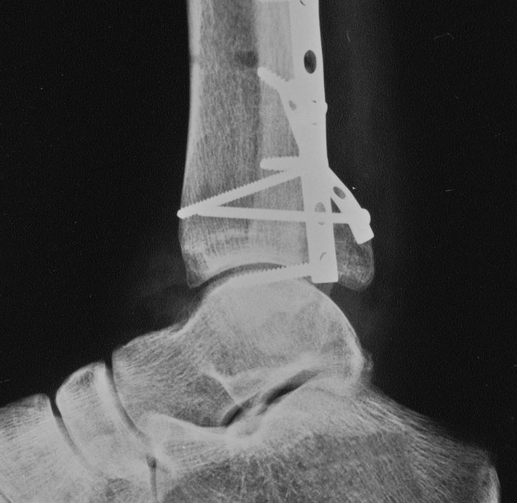 724 WEBER Foot & Ankle International/Vol. 25, No. 10/October 2004 Fig. 9: Lateral radiograph of patient no 1 (late reconstruction).