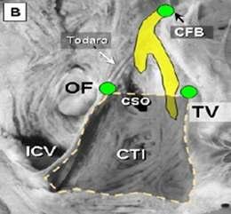 Targets for Ablation of Typical AFL Type of flutter CTI-dependant Partial isthmus dependant