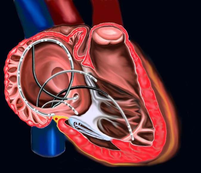 Catheter positions Catheter insertion & positioning(ii) - HRA : femoral access, Duodecapolar right atrium 을 circling 한다.