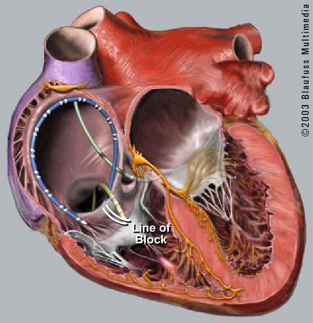 The yellow ablation catheter is placed in the