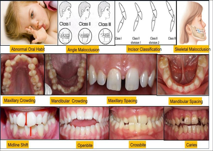 Prevalence of Malocclusion MATERIALS AND METHODS Table 1: Demographic information, selection criteria and armamentarium. Selection criteria Inclusive 1. Children from 9-11 year old. 2.