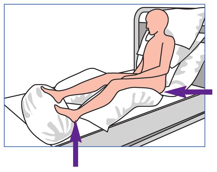 If you are in bed: If possible, change your position every two hours, alternating between your back and your sides.