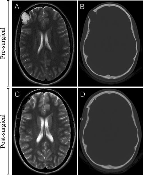This is illustrated by the case presentation and our data, which illustrate that patients presenting later in life for treatment may be at an increased risk for full-thickness cranial erosion.