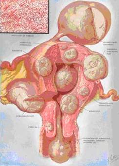 Coexistence of Endometriosis