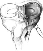 Articular cartilage contusion in 85 % of acute